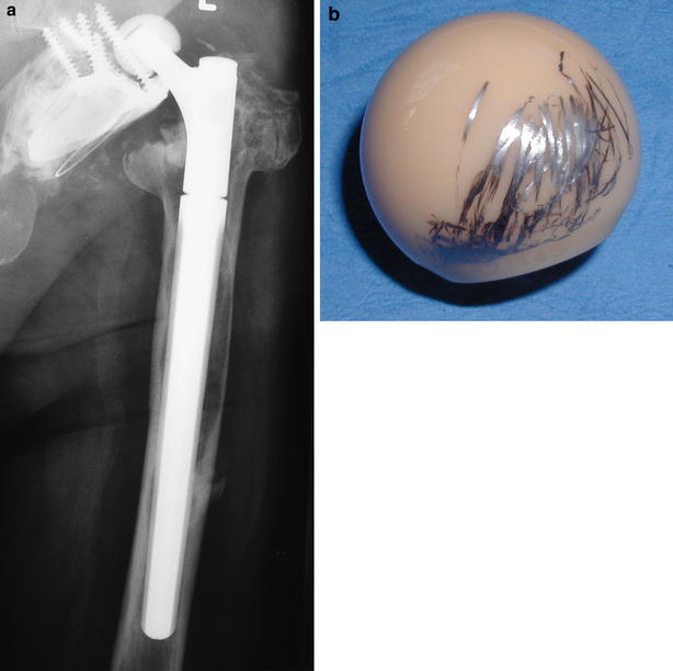 Transfer of metallic debris after dislocation of ceramic femoral heads