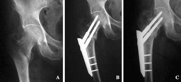 Stable osteosynthesis 02 image
