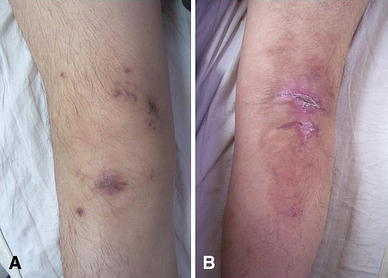 Septic arthritis of the knee caused by antibiotic-resistant ...