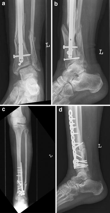 A multicentre case series of tibia fractures treated with the Expert ...