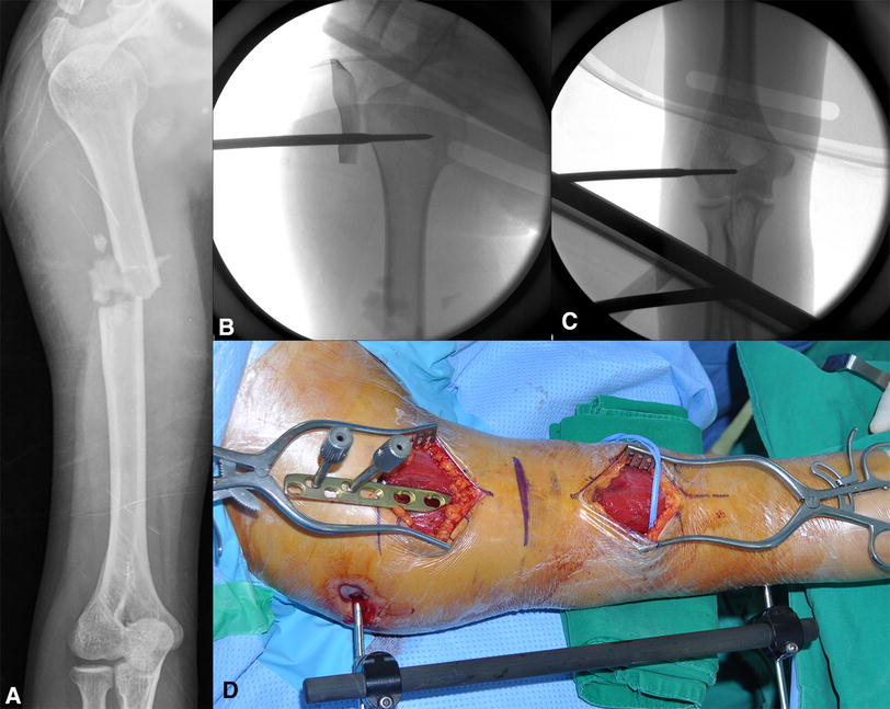 osteosynthesis technique Merging the principles of the miniplate osteosynthesis and compression osteosynthesis, the author suggests a new technique of angled eccentric osteosynthesis. osteosynthesis technique Merging the principles of the miniplate osteosynthesis and compression osteosynthesis, the author suggests a new technique of angled eccentric osteosynthesis.