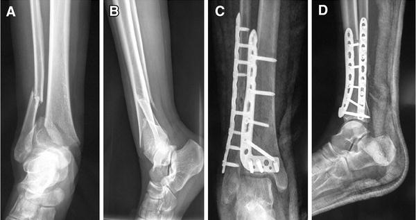 Single Incision Technique For The Internal Fixation Of