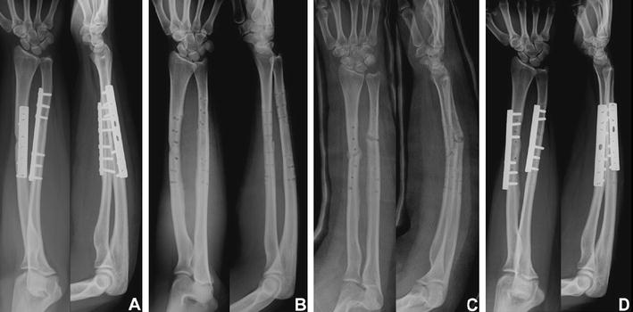 Removal of forearm plate leads to a high risk of refracture: decision ...