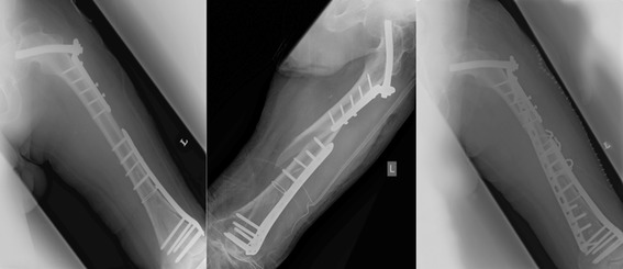 Non-prosthetic peri-implant fractures: classification, management and ...