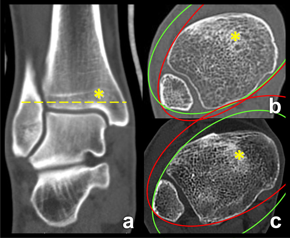 Pathoanatomy Of Maisonneuve Fracture Based On Radiologic And Ct