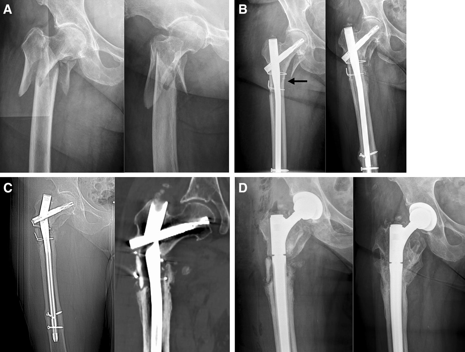 Tibial Shaft Fractures