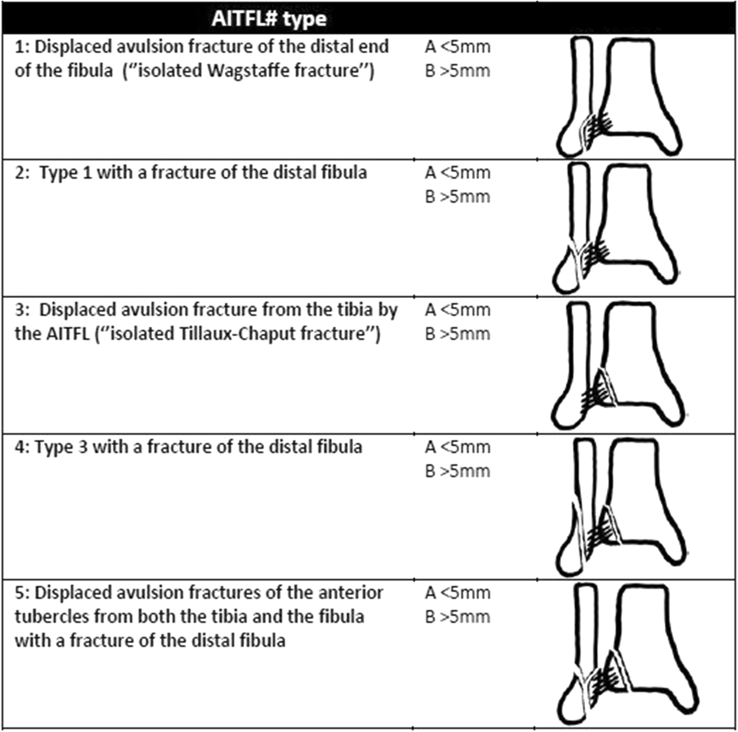 Anterior Inferior Tibiofibular Ligament Avulsion Fractures In Operatively  Treated Ankle Fractures: A Retrospective Analysis – Sogacot