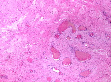 Aggressive angiomyxoma of the vulva: a case report and review of