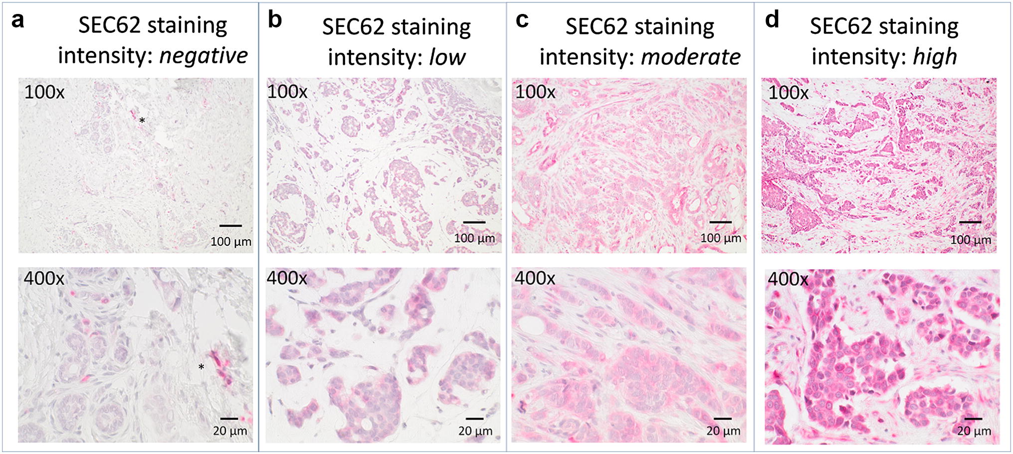Identification Of 3q Oncogene Sec62 As A Marker For Distant