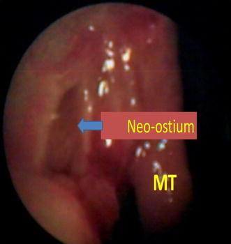 stents endoscopic dcr