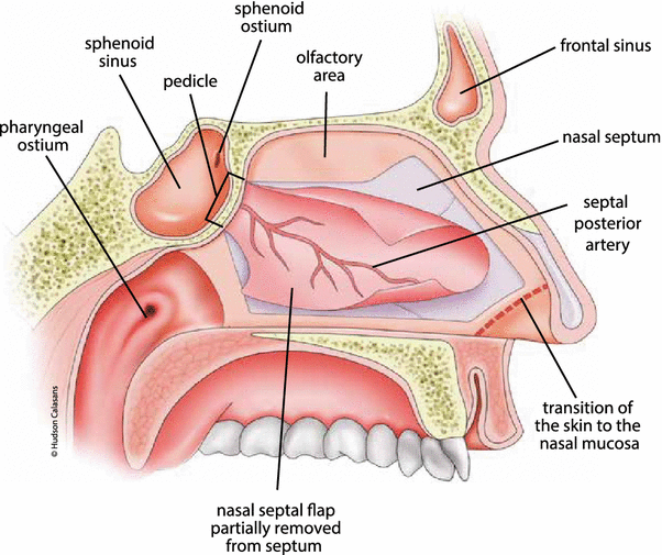 diagram of sphenoid sinuses wiring block diagram Infraorbital Foramen lateral sphenoid sinus recess cerebrospinal fluid leak a case sphenoid and ethmoid sinus diagram of sphenoid sinuses