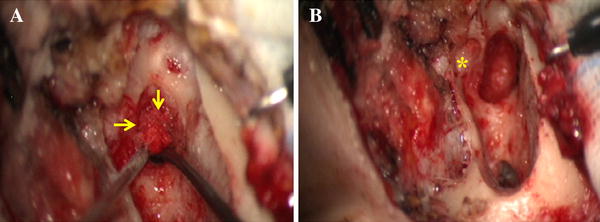first bite syndrome causes first bite syndrome causes