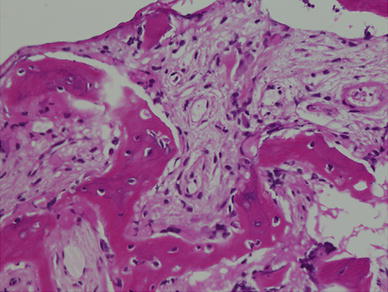 first bite syndrome causes first bite syndrome causes