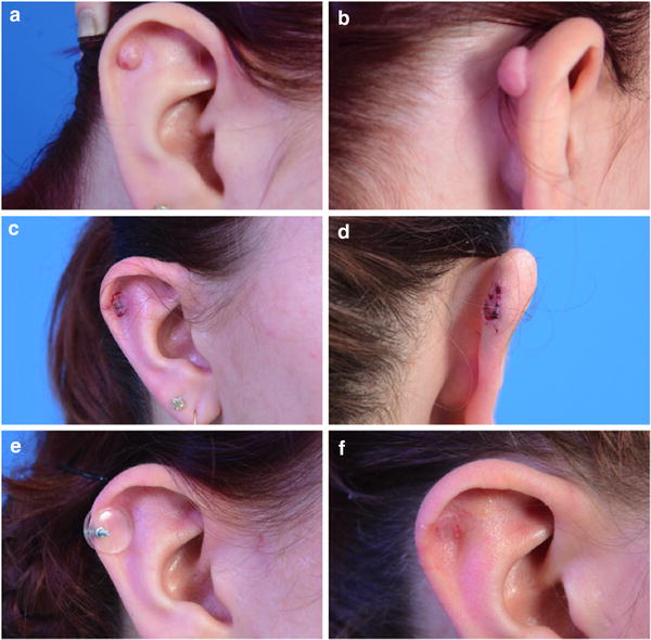 Treatment of ear keloids algorithm for a multimodal therapy regimen