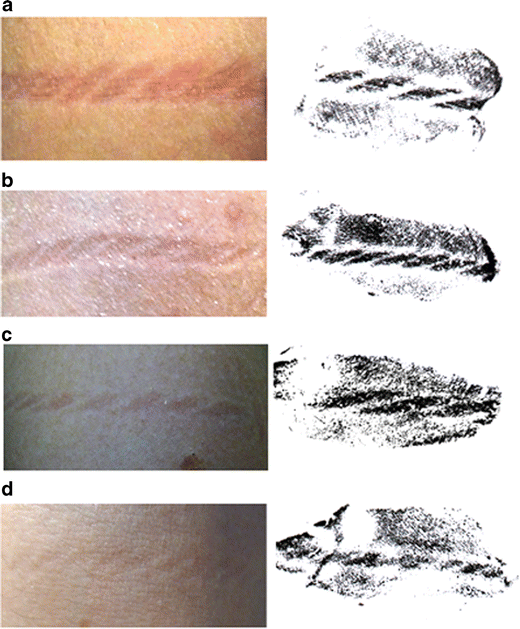 The persistence of ligature marks towards a new protocol for victims