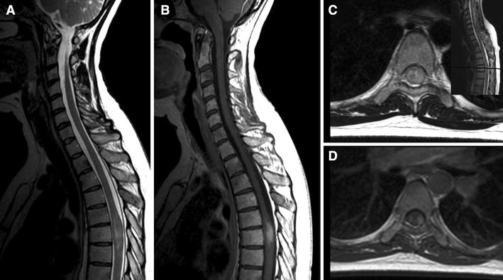 Erdheim–Chester disease presenting with an intramedullary spinal cord ...