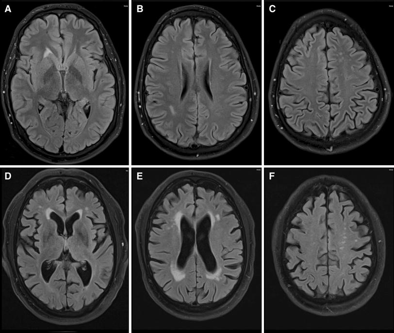 Imaging features in conventional MRI, spectroscopy and diffusion