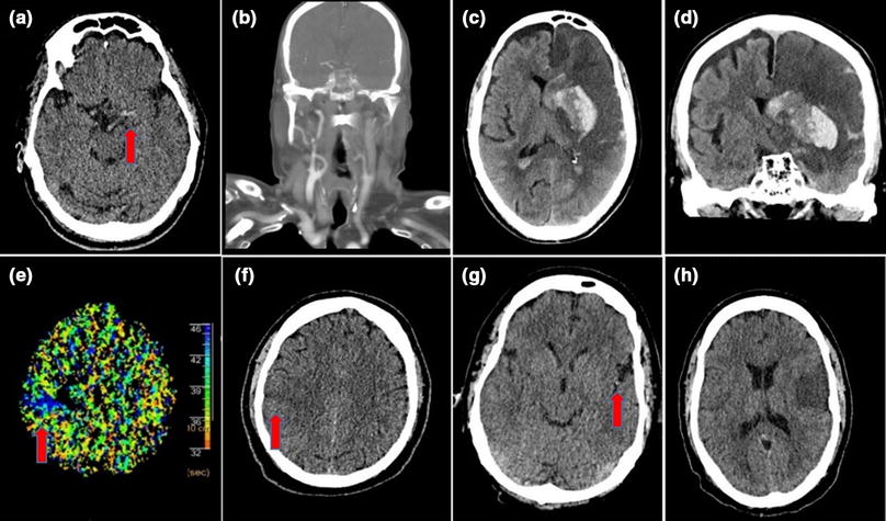 idarucizumab reversal idarucizumab reversal