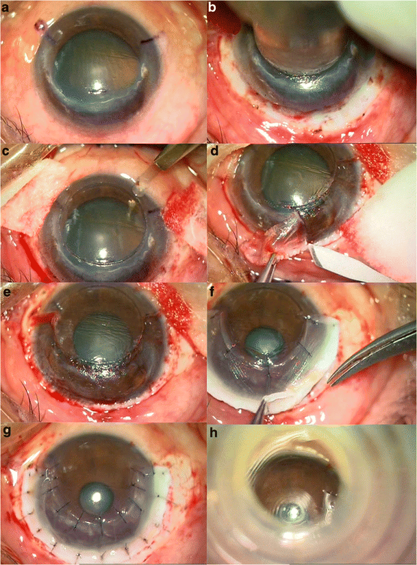 pellucid area definition pellucid area definition