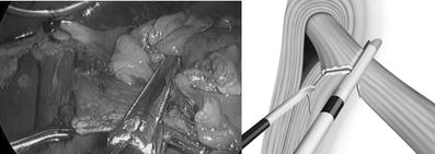 Outcome Of Overlap Anastomosis Using A Linear Stapler After ...