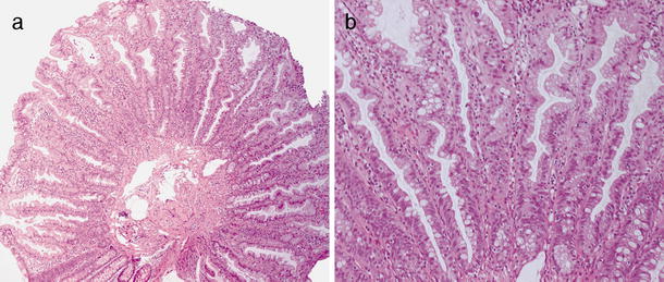 fragments of tubular adenoma and hyperplastic polyp fragments of tubular adenoma and hyperplastic polyp