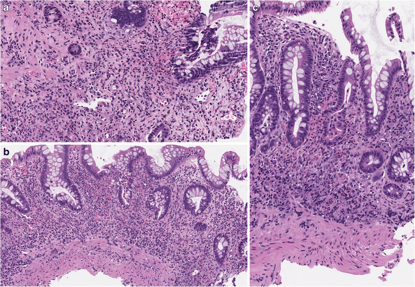Classification of eosinophilic disorders of the small and large