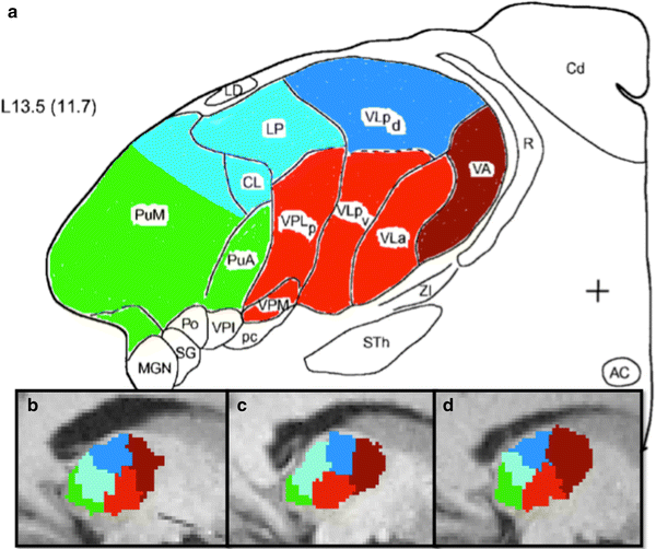 Robust Thalamic Nuclei Segmentation Method Based On Local - 