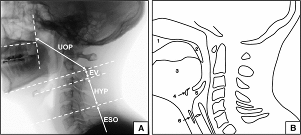 The Effect of the Cervical Orthosis on Swallowing Physiology and ...