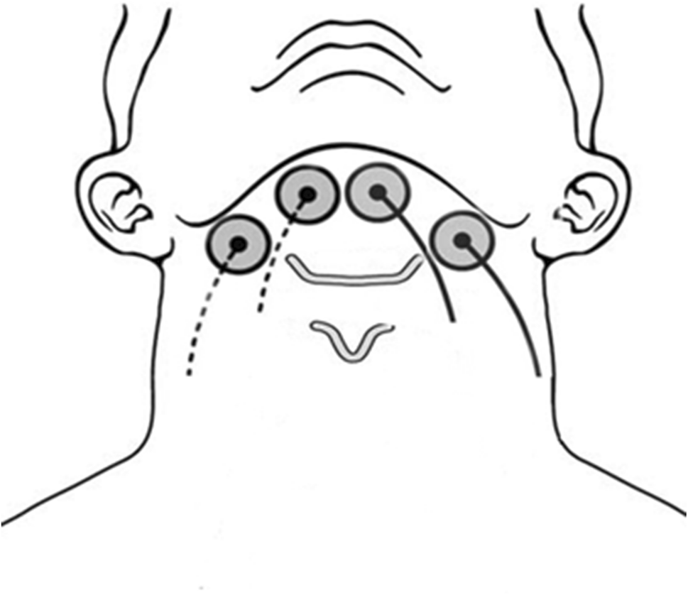 Vital Stim Electrode Placement Chart