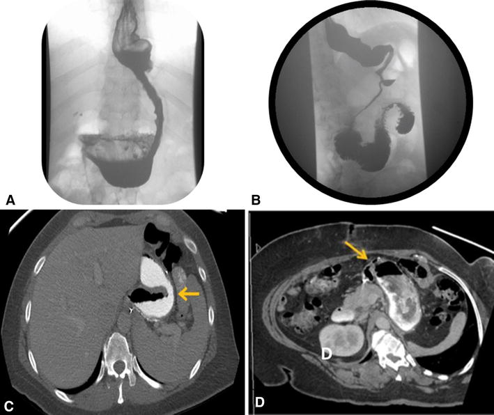 Endoscopic management of postlaparoscopic sleeve gastrectomy stenosis