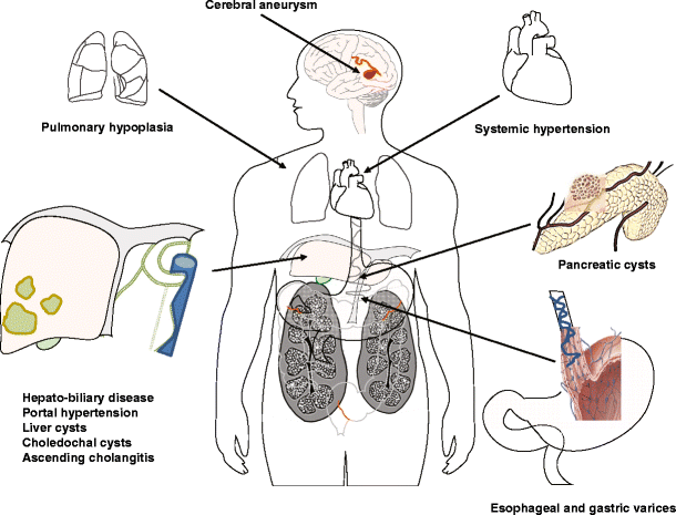 Clinical Manifestations Of Autosomal Recessive Polycystic - 