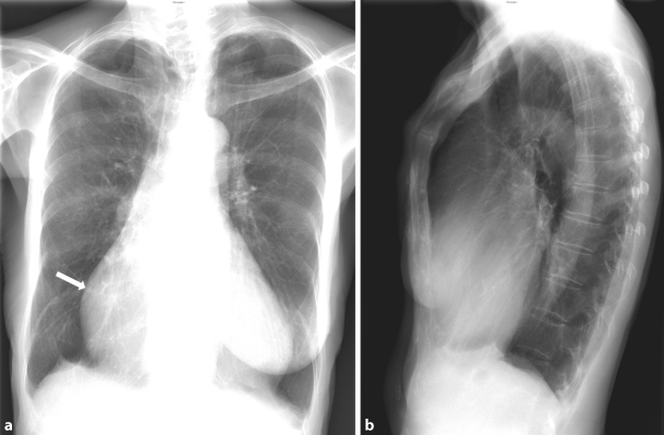 Restrictive Cardiomyopathy 