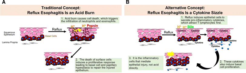 Reflux Esophagitis And Its Role In The Pathogenesis Of Barrett S reflux esophagitis and its role in the