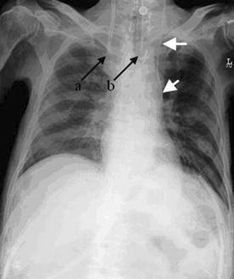 Rare malposition of a central venous catheter into the left internal ...