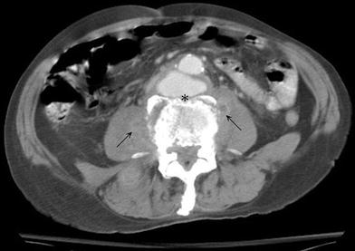 Spontaneous infective spondylitis and mycotic aneurysm 