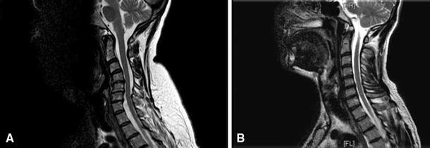 How old is your cervical spine? Cervical spine biological age: a new