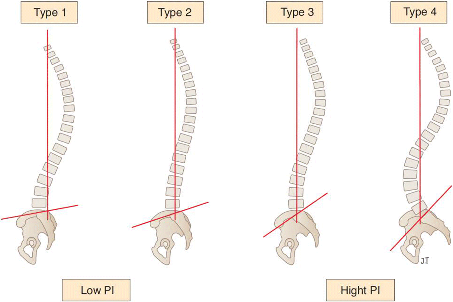 Sagittal balance of the spine  SOGACOT - Sociedad Gallega de