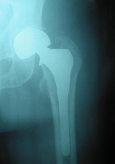 Intraoperative Fractures During Uncemented Furlong Bipolar Hemiarthroplasty Springerlink