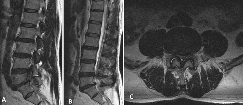 Isolated unilateral vertebral pedicle fracture caused by a back massage