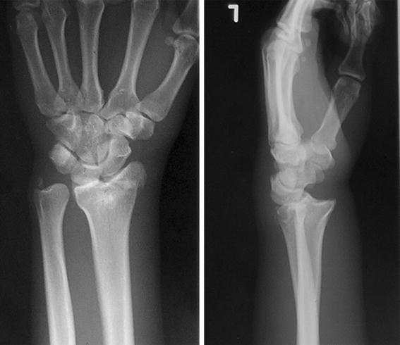 A case of acute dorsal radiocarpal dislocation with radial styloid ...