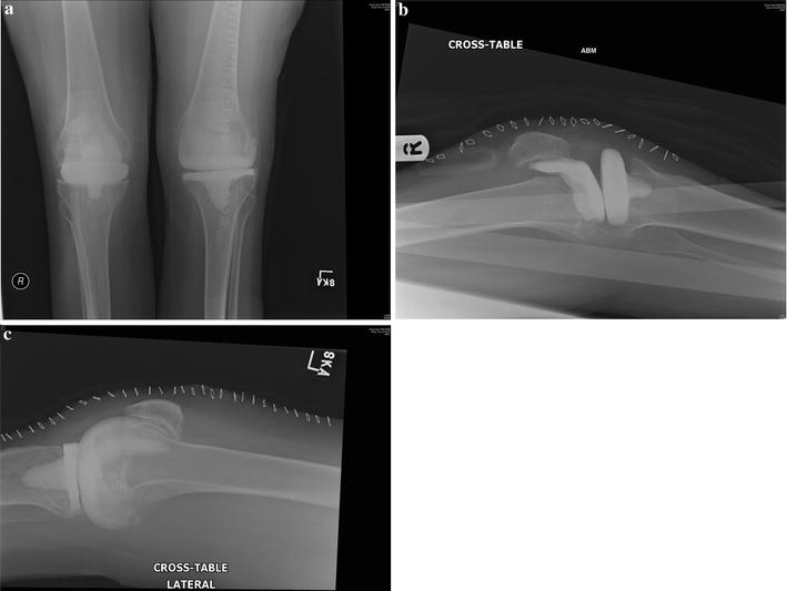 Bilateral knee replacements for treatment of acute septic arthritis in