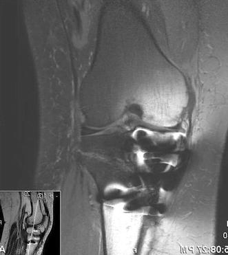 fig open marrow edema wedge painful tibial osteotomy bone treatment