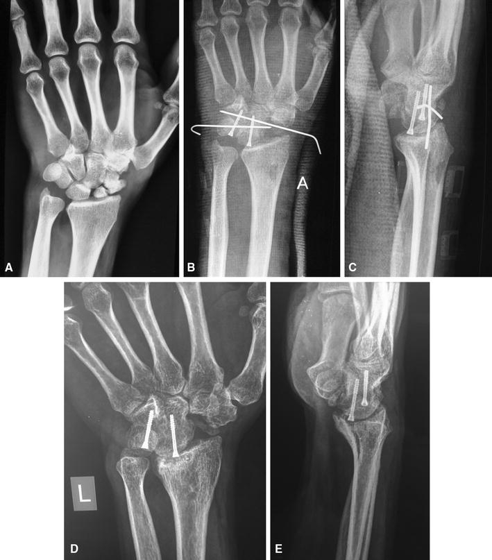 Fourcorner fusion of the wrist clinical and radiographic of