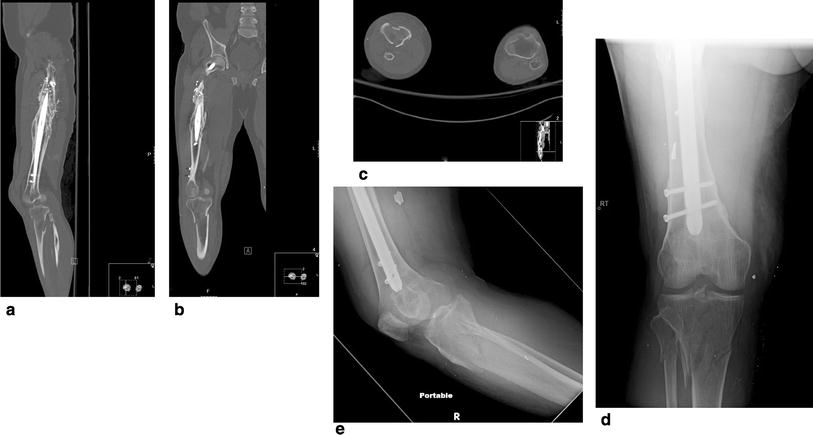 The Impact Of Acute Compartment Syndrome On The Outcome Of