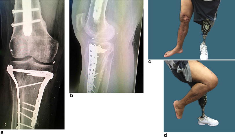 Left tibial plafond fracture icd 10