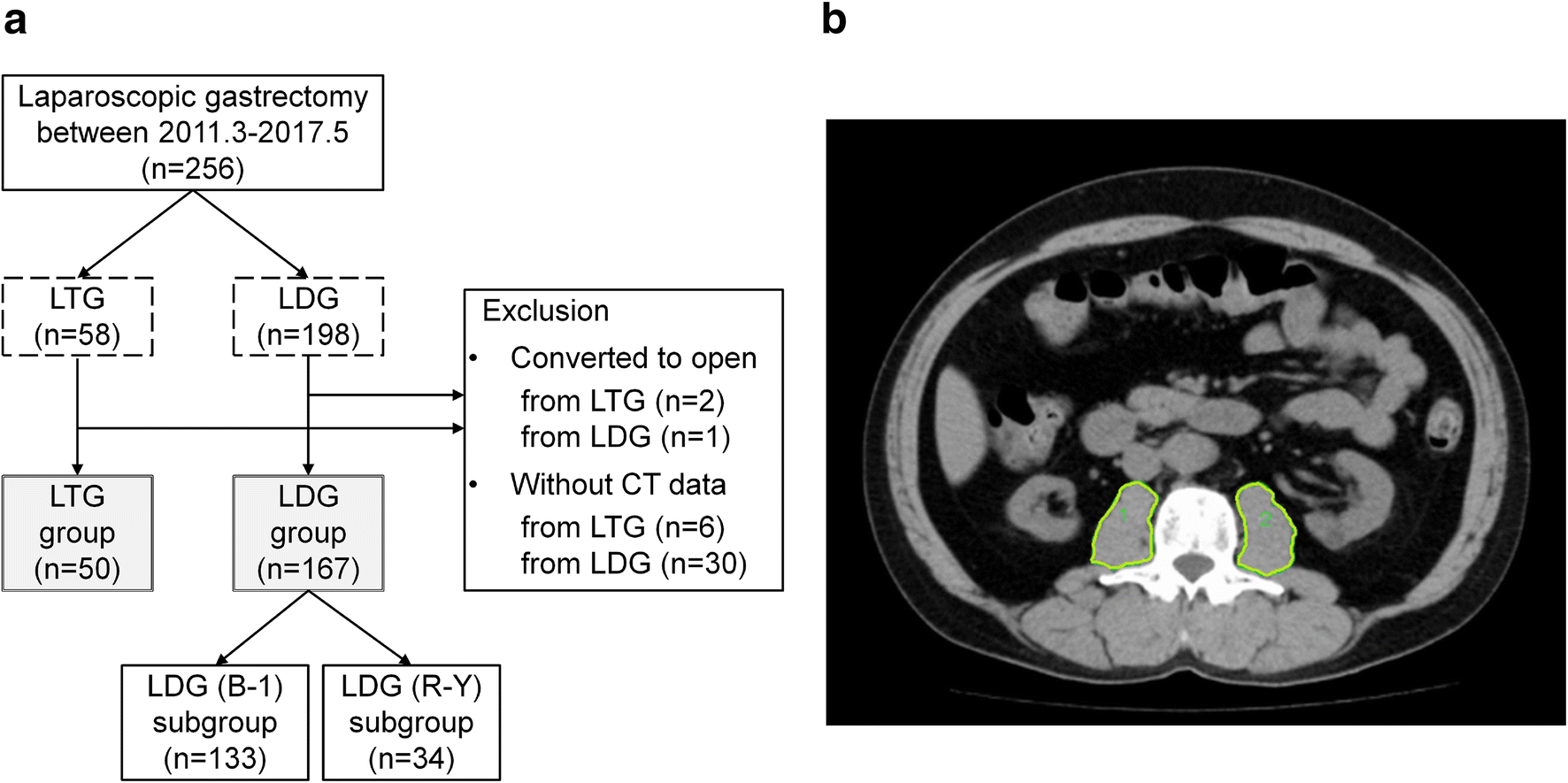 Skeletal Muscle Loss After Laparoscopic Gastrectomy Assessed By Measuring The Total Psoas Area Springerlink