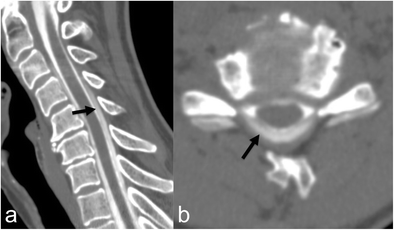 spontaneous cerebrospinal fluid leak spontaneous cerebrospinal fluid leak