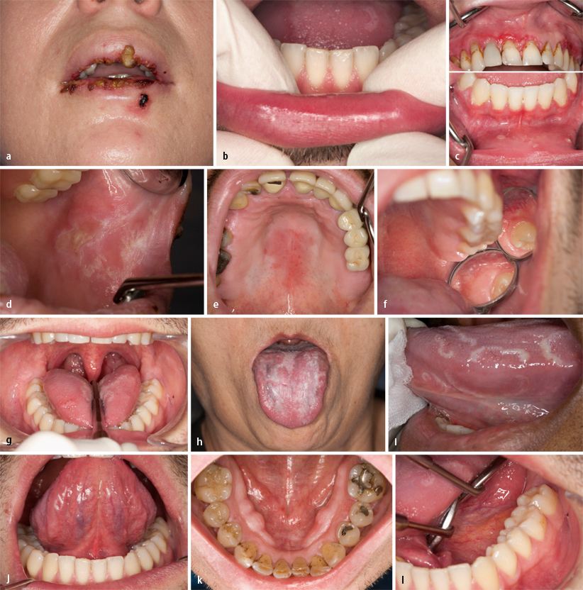 Klinische Differenzialdiagnose von oralen Schleimhautveränderungen