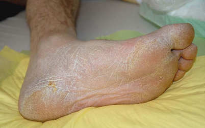 Das diabetische Fußsyndrom | SpringerLink