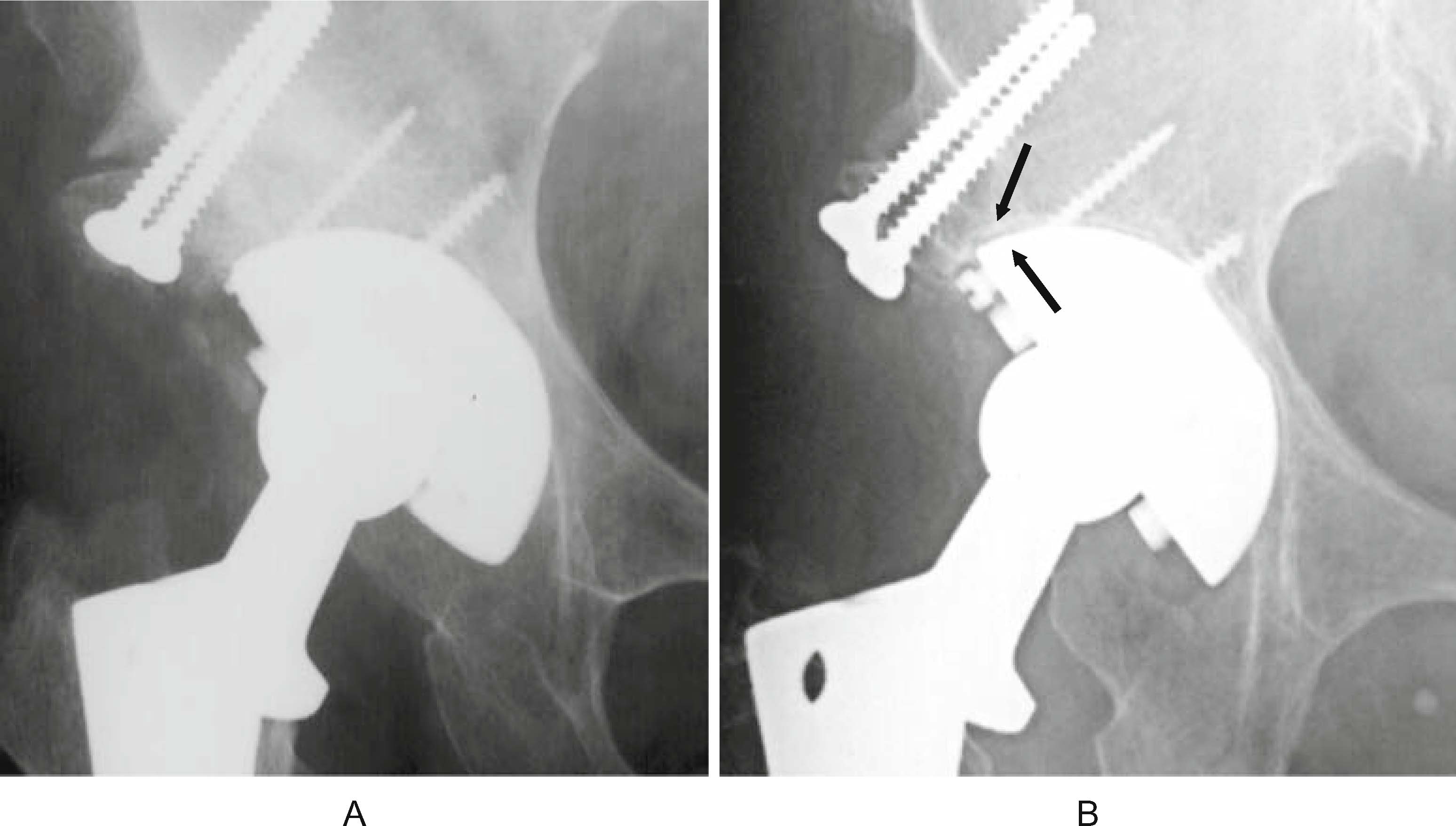 Cementless total hip replacement past, present, and future SpringerLink
